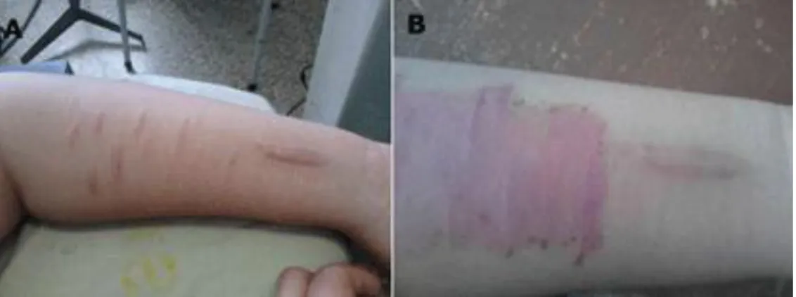 Fig. 2. A) Preoperatorio, B) Postoperatorio (mes)  Caso 3 