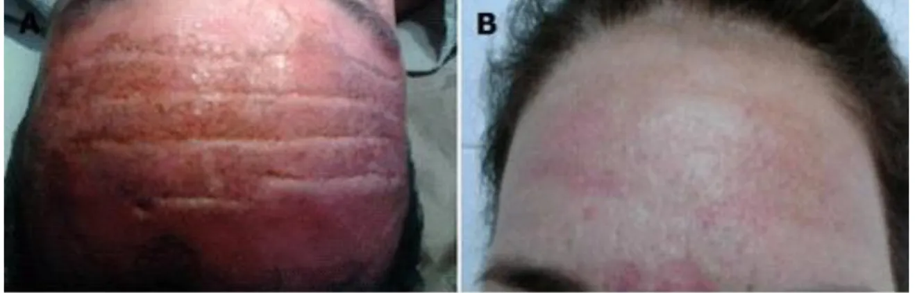 Fig. 4. A) Preoperatorio, B) Postoperatorio(21 días)  Caso 5 