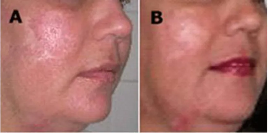 Fig. 6. A) Preoperatorio, B) Postoperatorio (3 meses) 