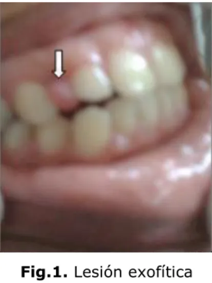 Fig. 2. Rx periapical con reabsorción ósea 