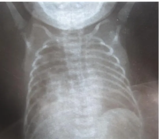 Fig. 1. Radiografía simple de tórax. 