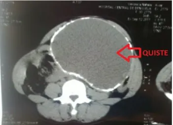 Fig. 1. TAC abdominal donde se observa el tamaño y  