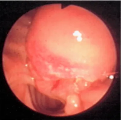 Fig. 2. Se observó una zona sobreelevada, eritematosa 