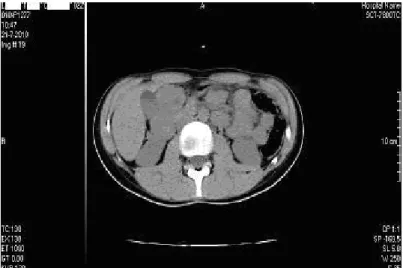 Fig. 2. Tomografía  axial  computarizada  simple       
