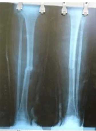Fig. 1 Rx simple de tibia y peroné vista PA 