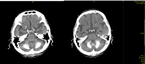 Fig. 1. TAC simple de cráneo. Se observan calcificaciones groseras, simétricas y bilaterales  cerebelosas, sin comprometer el IV ventrículo 