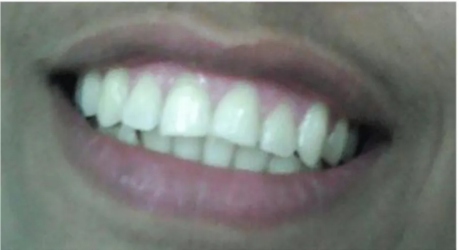 Fig. 2. Recuperación del color del diente 11 