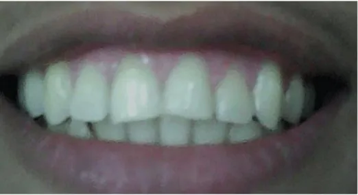 Fig. 3. Mantenimiento  del color del diente pasados 12 meses del tratamiento 
