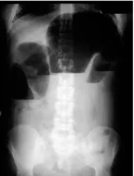 Fig. 1. Asa de colon distendida 
