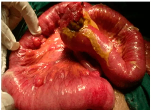 Fig. 2. Divertículo yeyunal perforado 