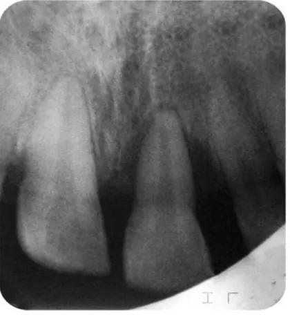 Fig. 1. Pérdida ósea con patrones de destrucción vertical y horizontal. 