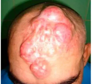 Fig. 1. Lesiones que ocupan casi todo el scalp 