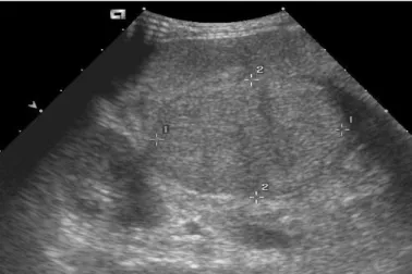 Fig. 1. Ultrasonido abdominal donde se apreció una tumoración  