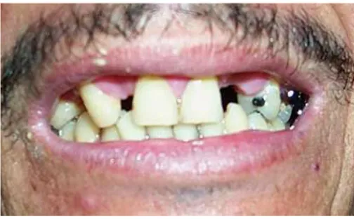 Figura 1. Existencia de caries dentales,  número de dientes extraídos y sin  restitución protésica 