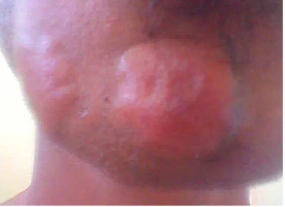 Fig. 1. Nódulos  leprosos 