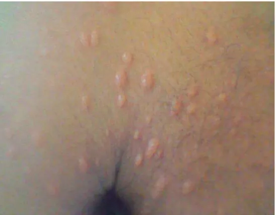 Fig. 2. Nódulos  leprosos 