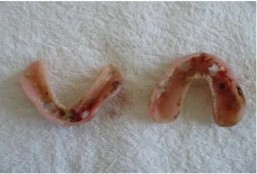 Fig. 1: Base mucosal  de la prótesis inmediatamente  retiradas. 