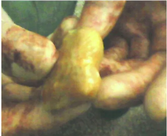 Fig. 4. Litopedion de 18 semanas. 