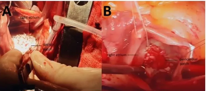 Figure 1. Two patients who underwent surgical closure of ASD. Operation images of patients in whom dacron  