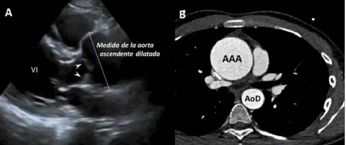 Figura 3. A. Aneurisma de aorta ascendente (AAA) en un paciente que fue operado de urgencia