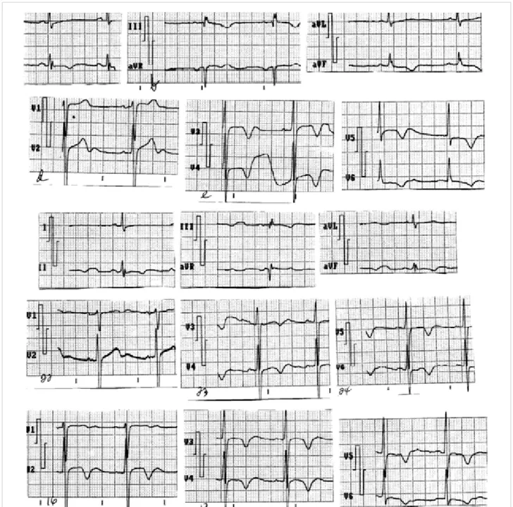 Figure 2. Electrocardiograms of the same patient at different times in his evolution: long QT interval due to drugs,  alterations of the T wave (in magnitude, duration, bimodalism, T1T2 wave)