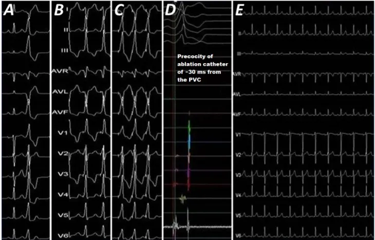Figure 4. Different records during the electrophysiological study A. Morphology of the PVCs in the summit of the left 