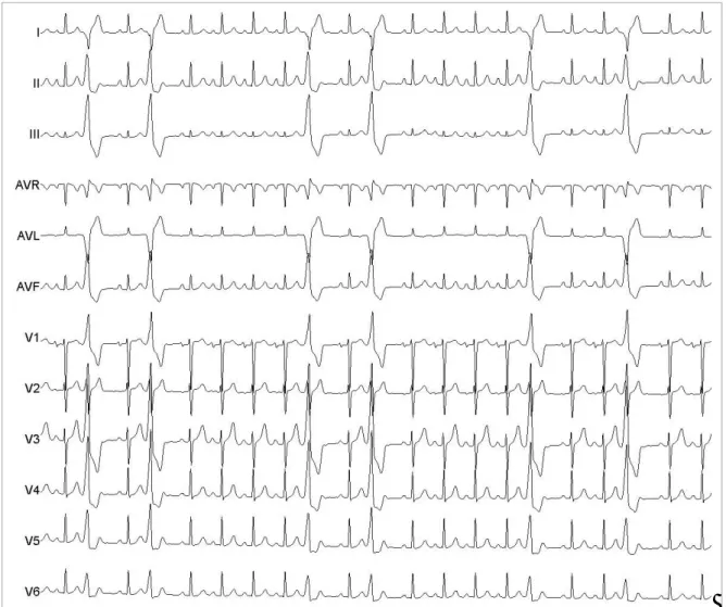 Figura 1. Morfología de las extrasístoles ventriculares en las 12 derivaciones del electrocardiograma