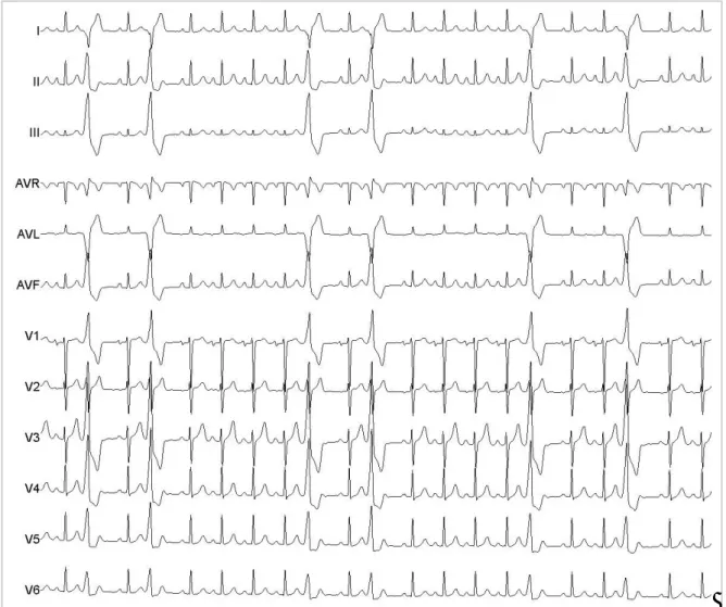 Figure 1. Morphology of premature ventricular contractions in the 12 leads of the electrocardiogram