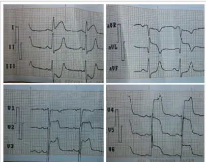 Figure 1. Initial electrocardiogram in the emergency department.  Note the ST segment elevation in D I , aVL and V 2 -V 6 , with 