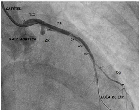 Figure 3. Opening of total occlusion of the circumflex artery. 