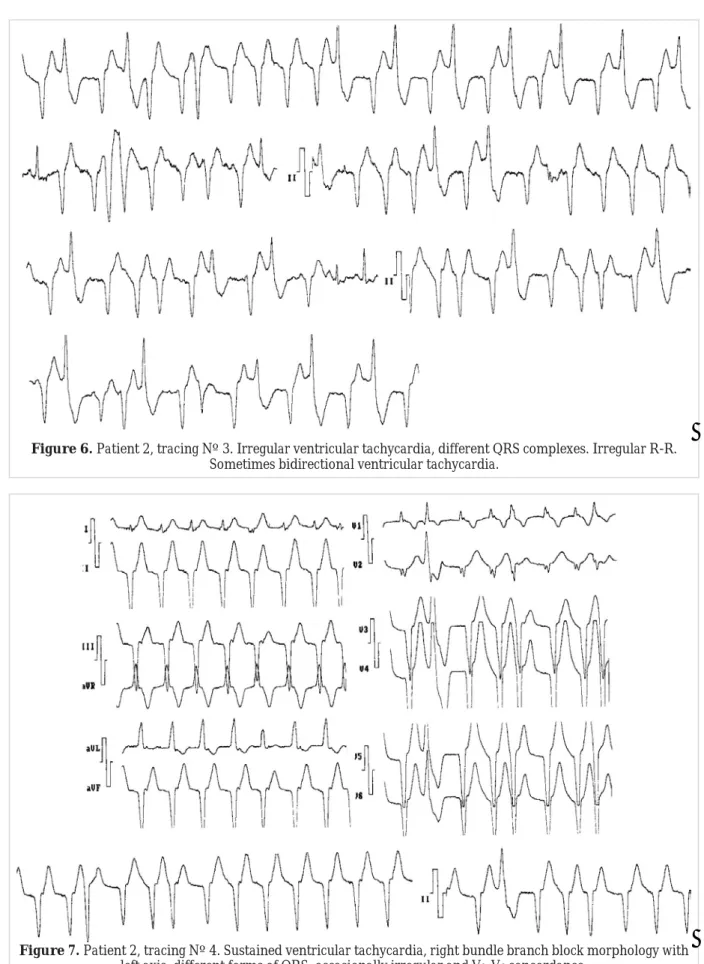 Figure 7. Patient 2, tracing Nº 4. Sustained ventricular tachycardia, right bundle branch block morphology with 