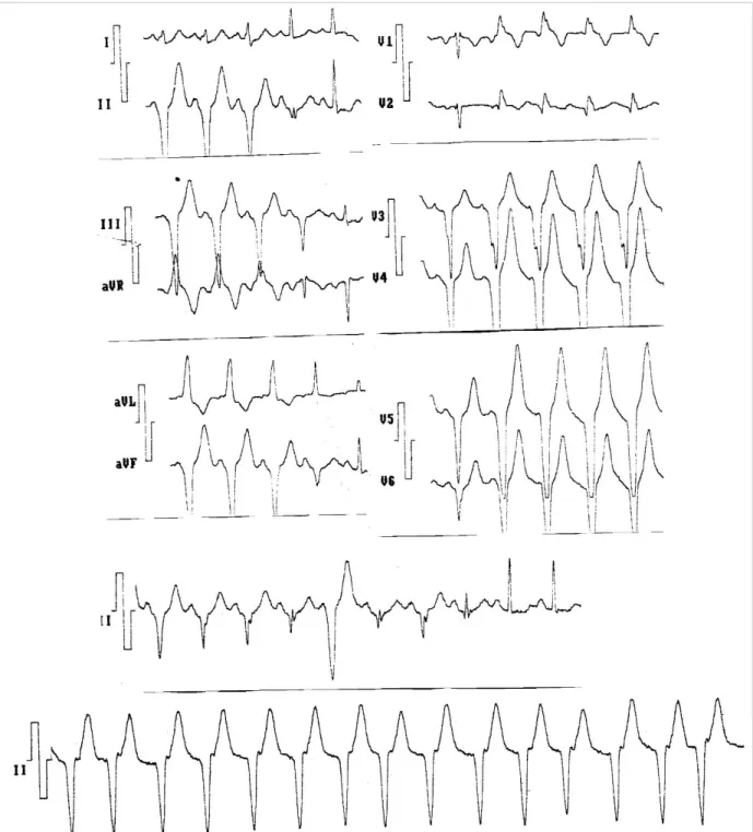 Figure 8. Patient 2, tracing Nº 5. Ventricular tachycardia, sometimes fusion and sinus complexes.