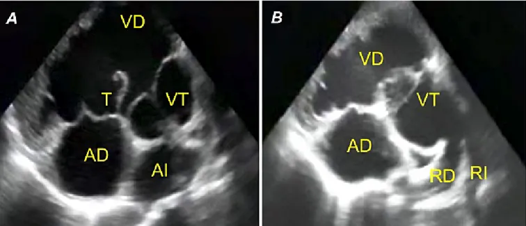Figura 2. A. Vista de eje corto paraesternal alto, donde se visualiza el vaso troncal, ventrículo derecho dilatado y tejido 