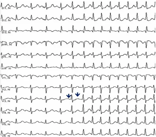 Figure  1.  12-lead electrocardiogram obtained from a 44-year-old woman during the  spontaneous episode of a common AVNRT, triggered by a pair of atrial extrasystoles  (arrows)