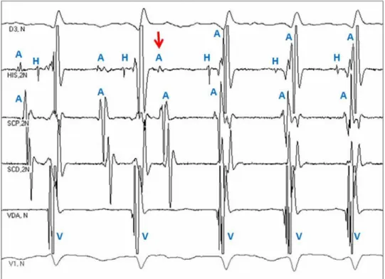 Figure 2. EPS of previous case. The first two are sinus beats. The arrow points to an atrial  extrasystole, which induces a considerable prolongation (over 50 ms) of AH interval  (compare it with the two previous AH  intervals)