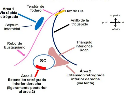 Figure  3.  Schematic representation of the earliest atrial activation sites during retro- retro-conducted impulses by fast and slow pathways