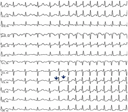 Figura 1. Electrocardiograma de 12 derivaciones obtenido de una mujer de 44 años de  edad durante la inducción espontánea de un episodio de TRIN común, desencadenada  por una pareja de extrasístoles auriculares (flechas)
