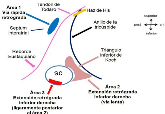 Figura 3. Representación esquemática de los sitios de activación auricular más precoces  durante impulsos retroconducidos por la vía rápida y lenta