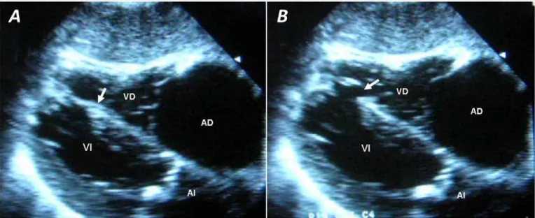 Figura 1. Rotura del septo interventricular. La flecha señala el defecto interventricular