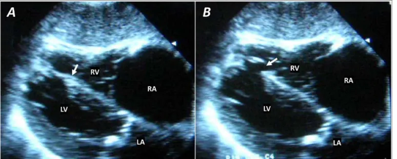 Figure 1. Interventricular septum rupture. The arrow indicates the ventricular septum defect