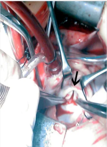 Figure 1. Cineangiography in left lateral view. A: successful  dilation of aortic coarctation