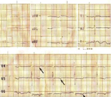Figure  1.  Electrocardiogram  in sinus rhythm with  T  waves 
