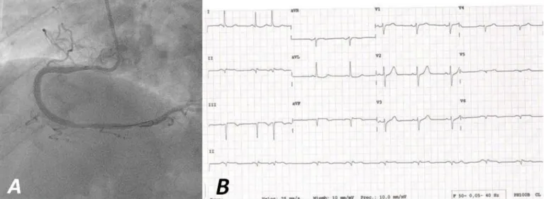 Figura 2. A. Coronaria derecha tras intervencionismo coronario con flujo TIMI 3. B. Electrocardiograma inmediato (en sala de 