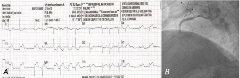 Figure 1. A. Electrocardiogram showing AF and subepicardial lesion indicating inferolateral AMI
