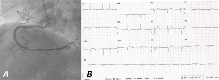 Figure 2. A. Right coronary artery after coronary intervention with TIMI 3 flow. B. Immediate electrocardiogram (PCI room) 
