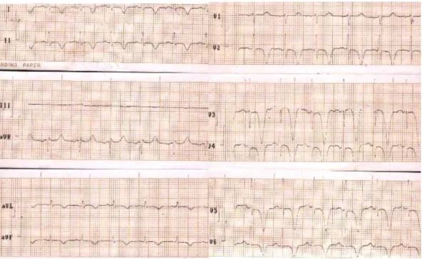 Figura 1. Electrocardiograma que muestra trastorno difuso de la repolarización ventricular
