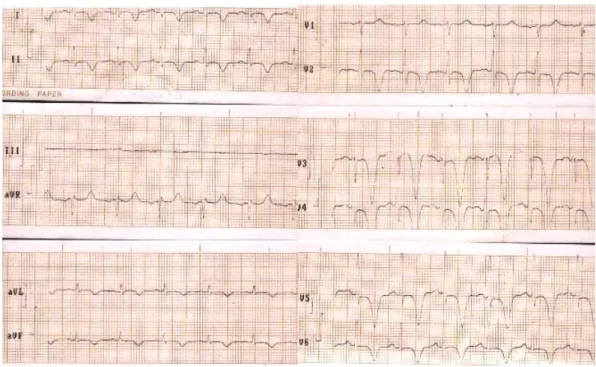Figure 1. Electrocardiogram showing diffuse disorder of ventricular repolarization. 