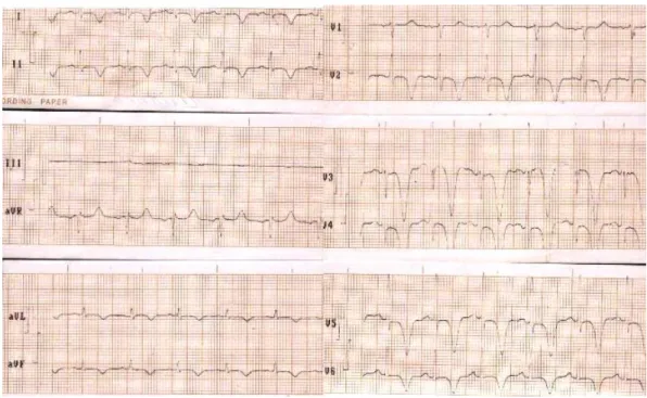 Figure 1. Electrocardiogram showing diffuse disorder of ventricular repolarization. 