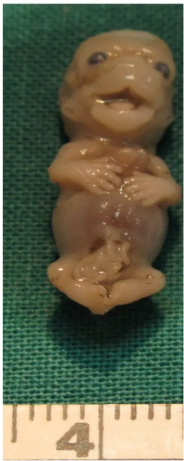Figure 2. Selective side left view of the thorax. cal exstrophy), and the heart are affected