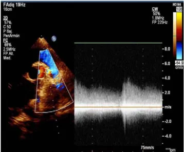 Fig 3. Tomografía computarizada helicoidal con re-